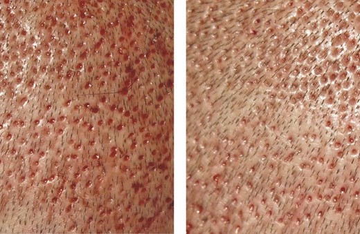 Close-up photos of scalp skin 1 days after an FUE hair transplant