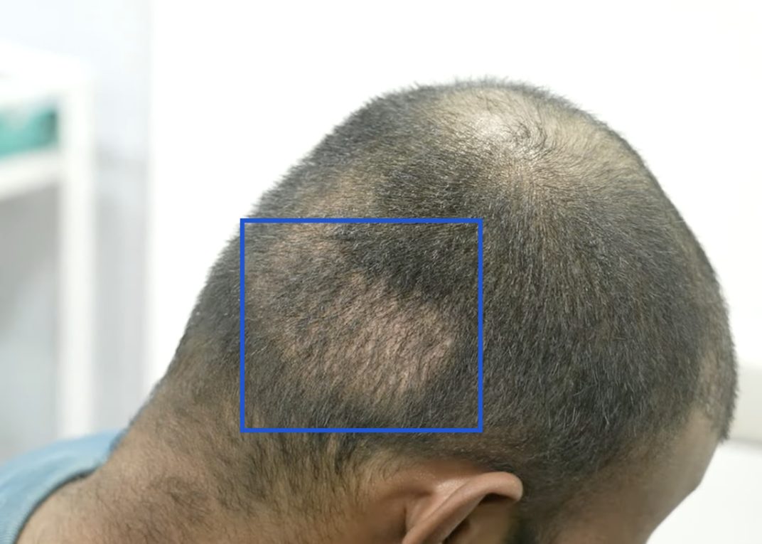 fue donor area after one month