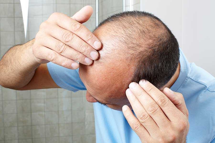 Male-pattern-baldness-linked-to-prostate-cancer-new-findings