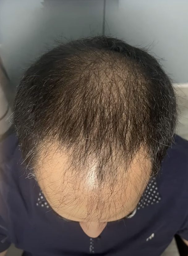 fue patient before hair transplant