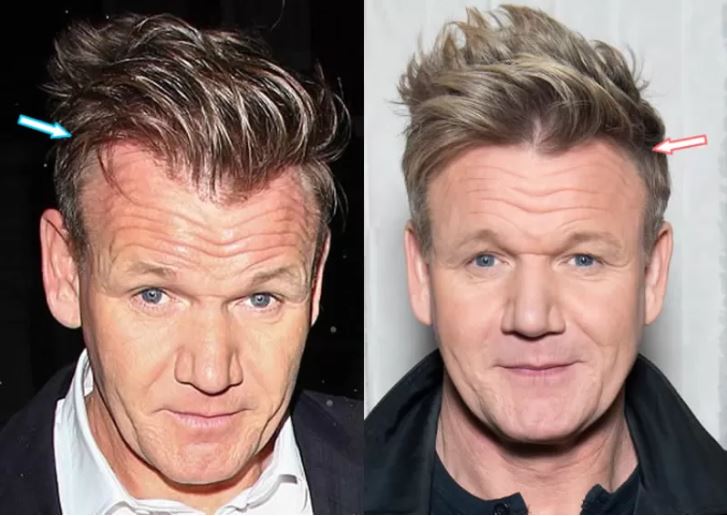 Gordon Ramsey before and after rumoured hair transplant