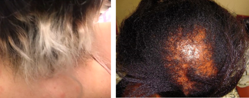 hair breakage due to chemical damage