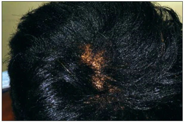 hair breakage in natural hair
