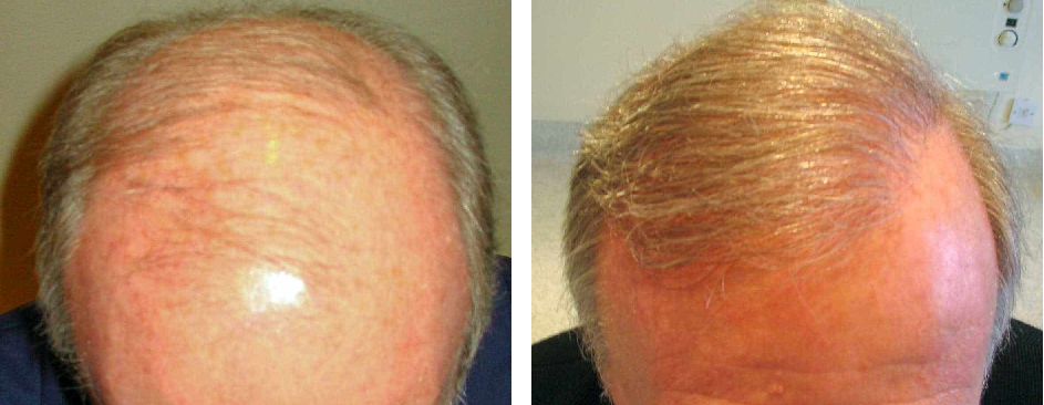 Before and 12 months after hair transplant procedure
