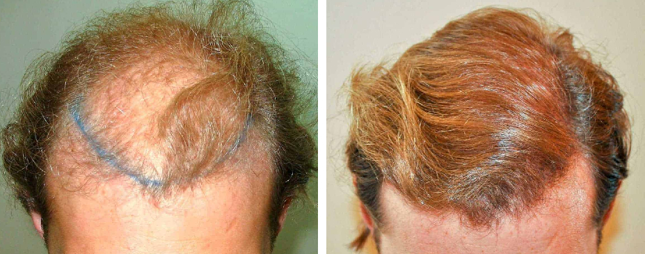 Results after 18 months post hair transplant surgery