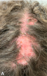 hair loss caused by folliculitis decalvans