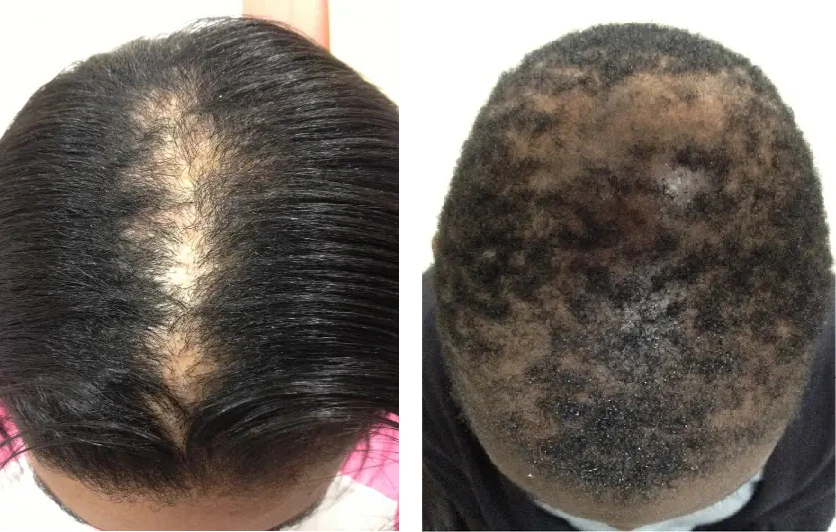 hair loss due to CCCA