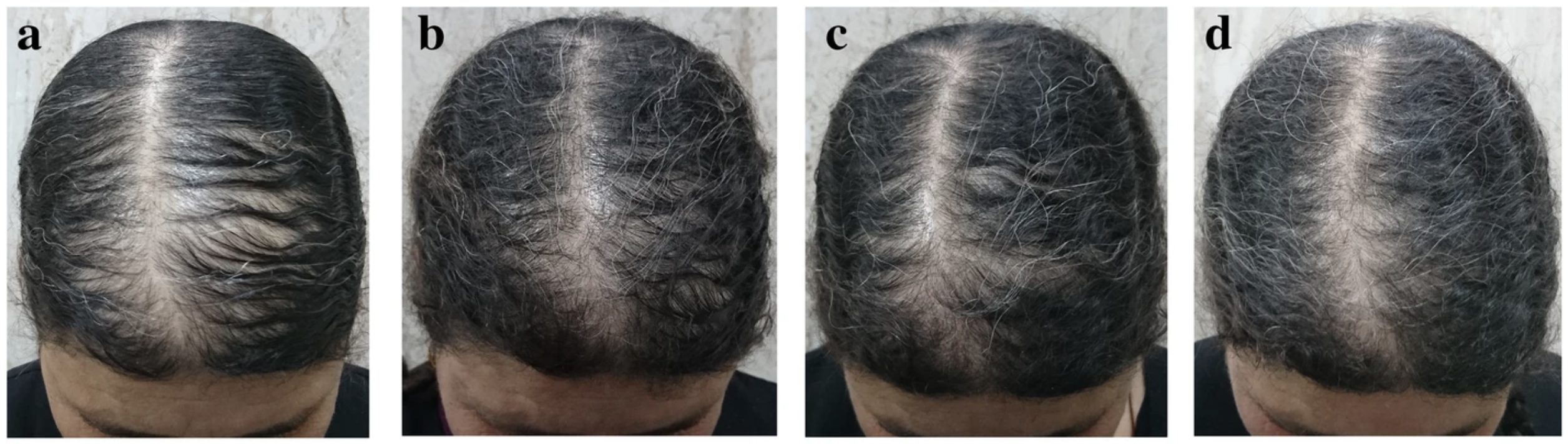 Improvement of thinning hair from androgenic alopecia due to the use of topical ketoconazole
