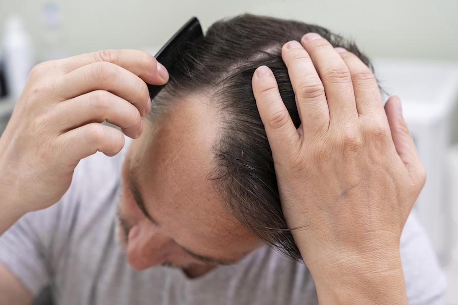 Does Combing Hair Upwards Cause Baldness