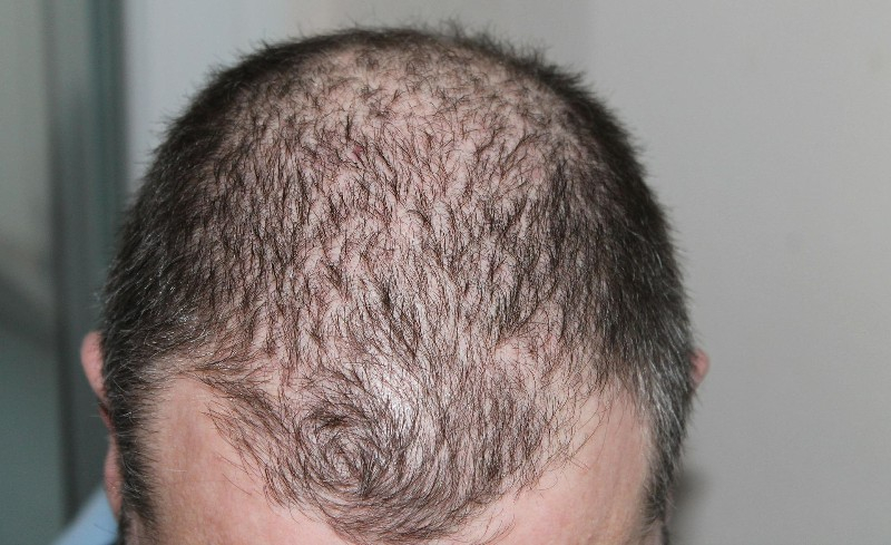 hair loss where the scalp can be seen through the scalp
