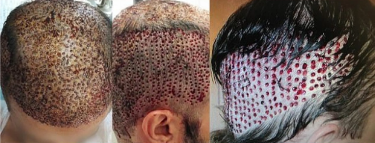 Examples of tryphophobia caused by outdated hair transplant techniques