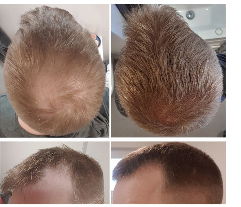 hair results before and after 9 months of finasteride use