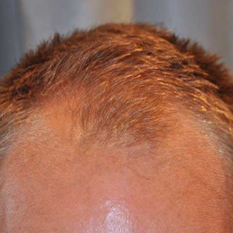 Do I need to increase blood flow to the scalp for better growth?