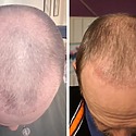 Hair Transplant After 2 Months: Photos, Results, Side Effects