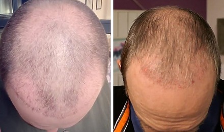 Hair Transplant After 2 Months Featured Image