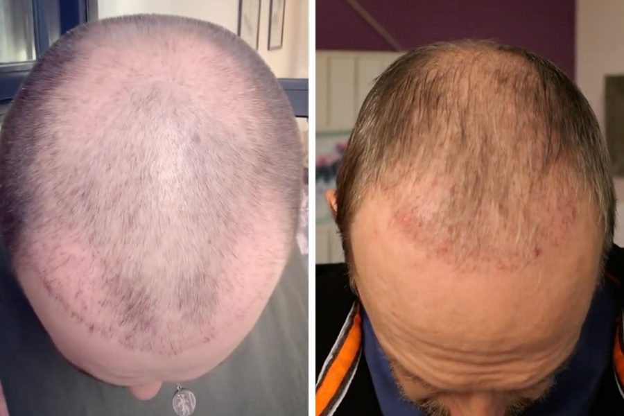 Hair Restoration Before  After Newport Beach  FUE Pictures  Dr Varona