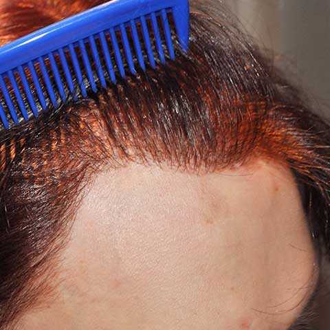 FUT Hair Transplant, Wimpole Clinic