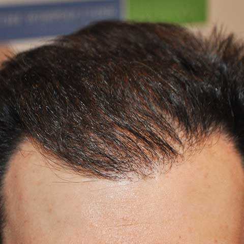 hair-transplant-after-3