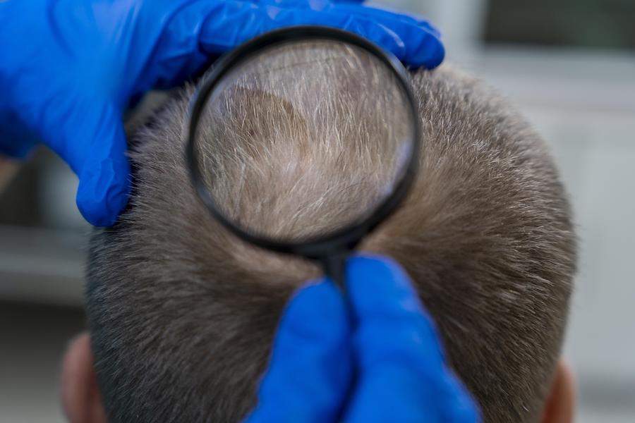 Hair Transplant After 4 Months Featured Image