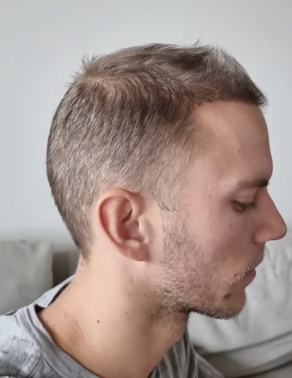 hair transplant after 4 months - profile