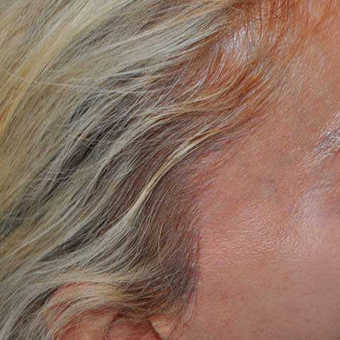 Female Hair Transplant, Wimpole Clinic