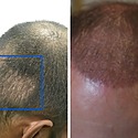 Hair Transplant After 1 Month: Photos, Results, Side Effects