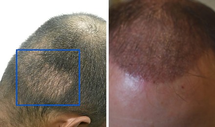 Donor Area And Transplanted Hair 1 Month After Hair Transplant Surgery