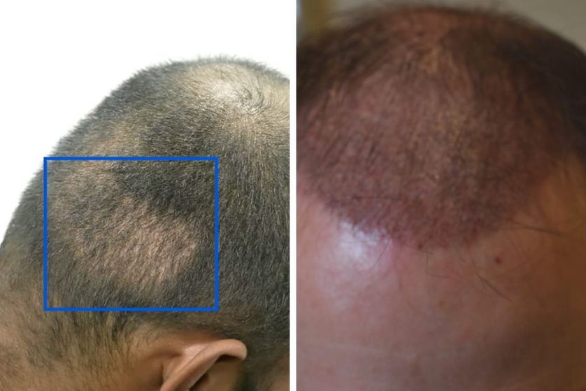 How to deal with hair transplant scabs Wimpole Clinic