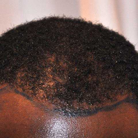 Afro Hair Transplant, Wimpole Clinic