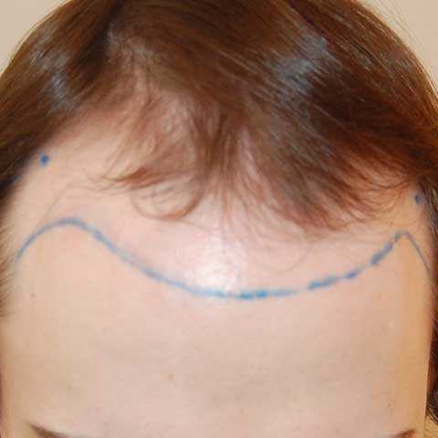 FUT Hair Transplant, Wimpole Clinic