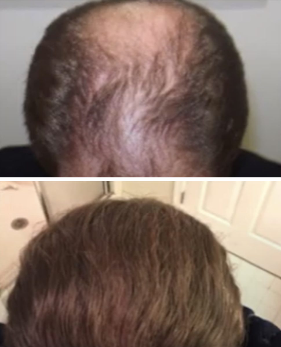 hair transplant before and after 10 years - patient 2