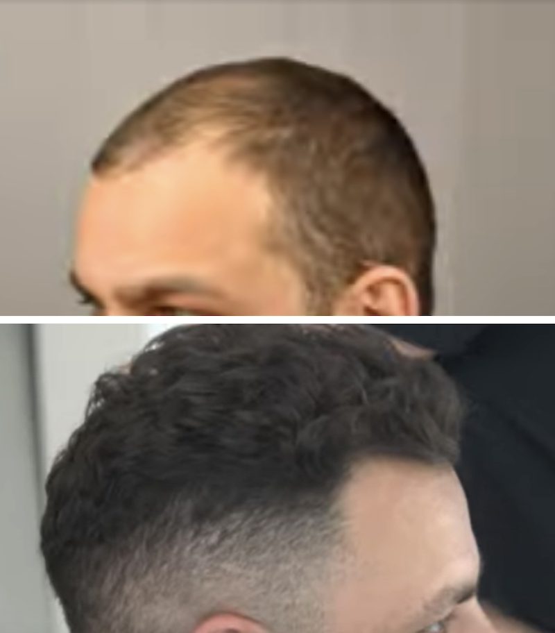 hair transplant before and after 10 years