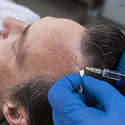 Hair Transplant Death Rate: Should You Be Worried?