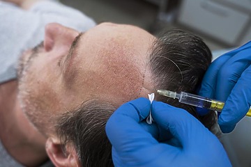 Man dies hours after hair transplant in Mumbai What are the side effects  and health risks associated with hair replacement surgery  Health Tips  and News