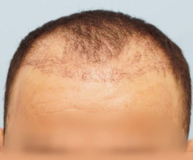 example of a failed hair transplant