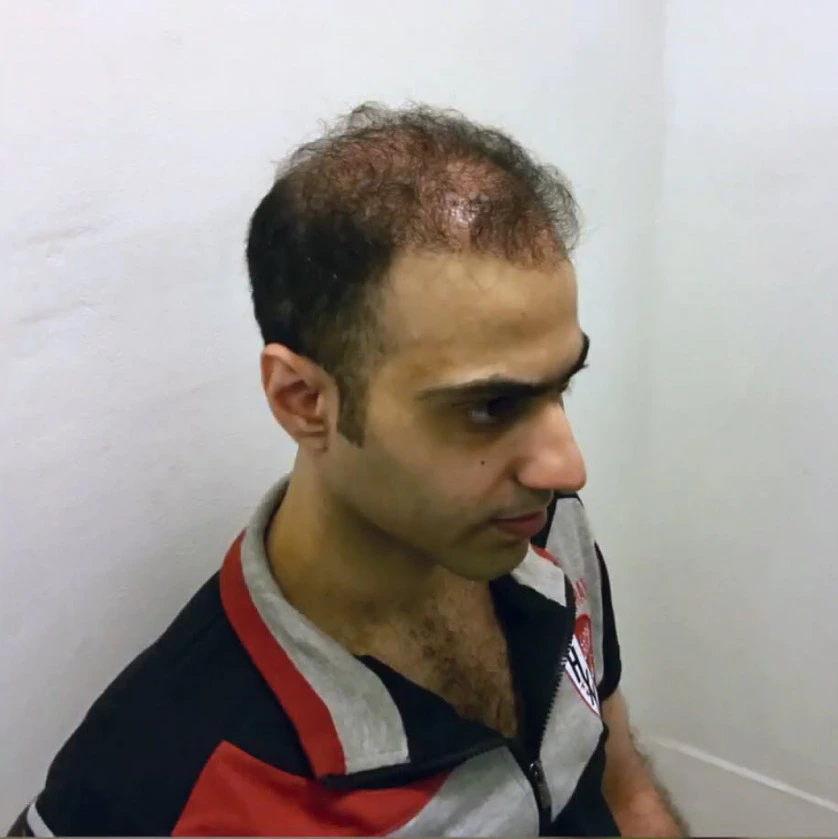 How To Fix A Messed Up Hairline, Wimpole Clinic