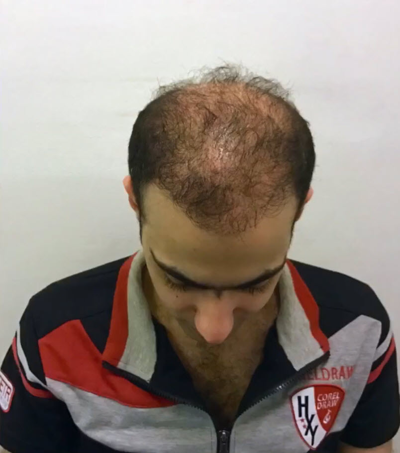 hair transplant gone wrong in turkey - ISHRS