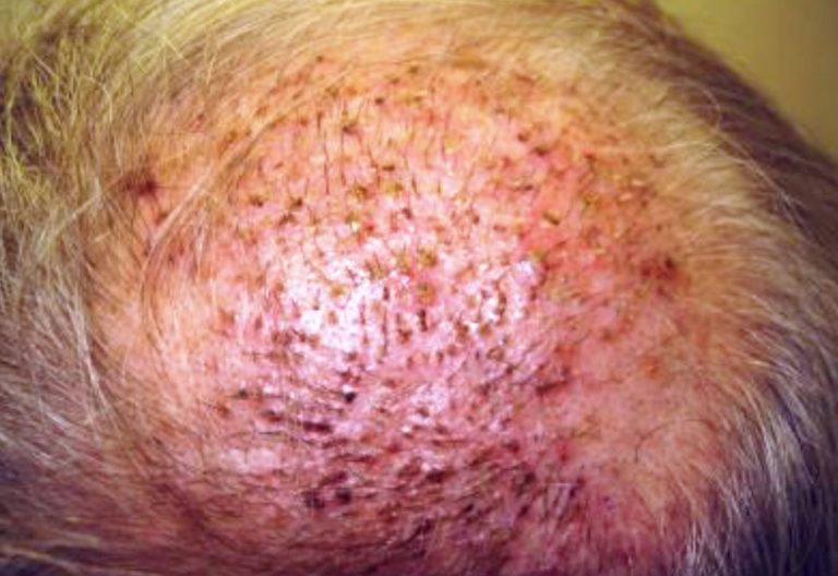 example of scalp infection