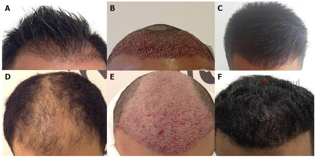 1 patients before hair transplant surgery, immediate after surgery, and 1 year post-transplant.