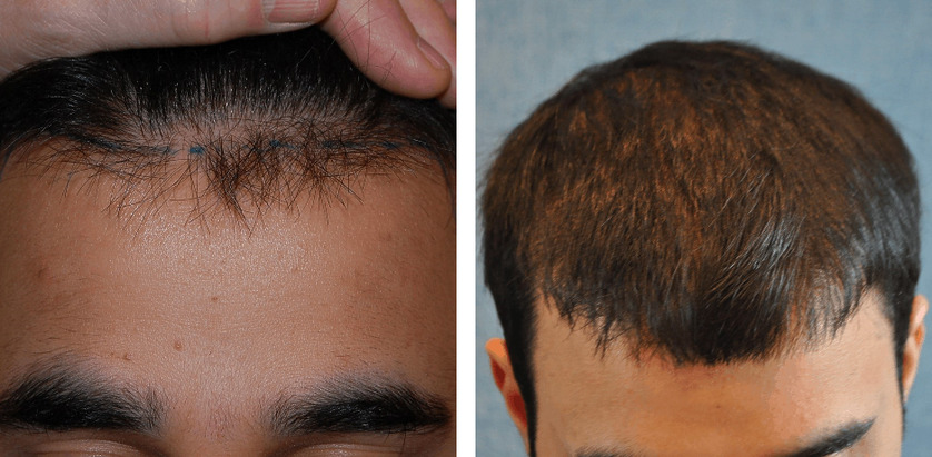 Can I Get A Hair Transplant At 25? | Wimpole Clinic