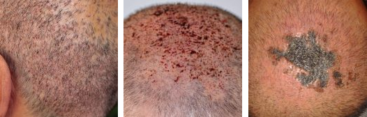 Examples of hair transplant infections