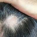 Hair Transplant Into Scar Tissue: Does It Work?