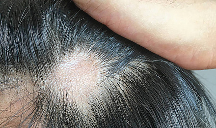 Hair Transplant Into Scar Featured Image