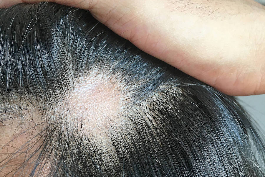 Hair Transplant Into Scar Featured Image