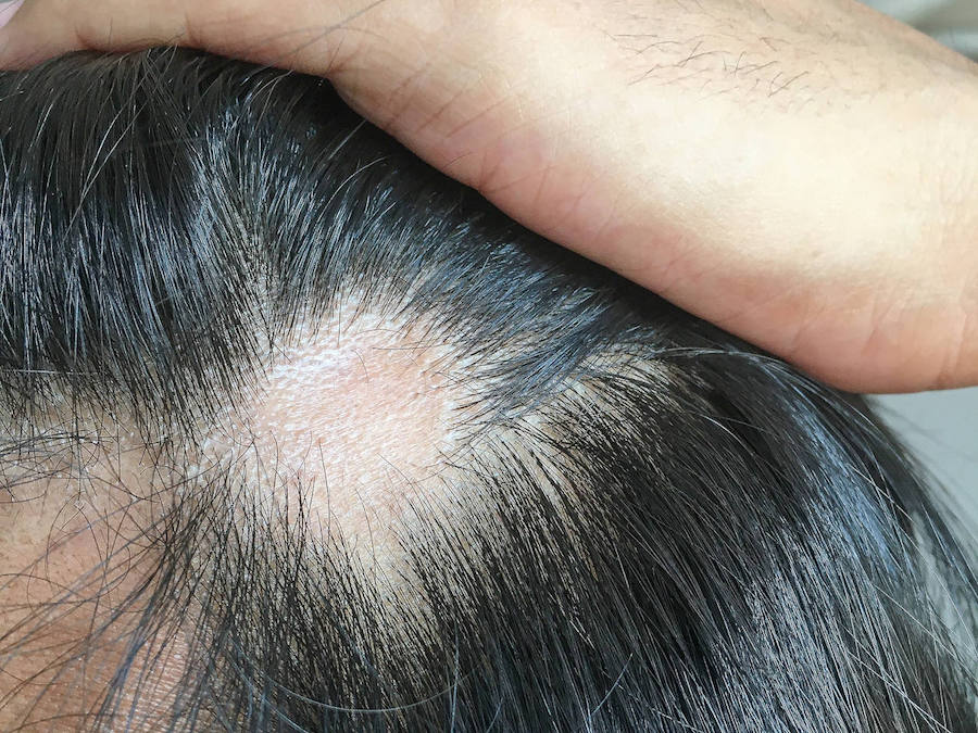 Hair Transplant Into Scar Tissue: Does It Work? | Wimpole Clinic