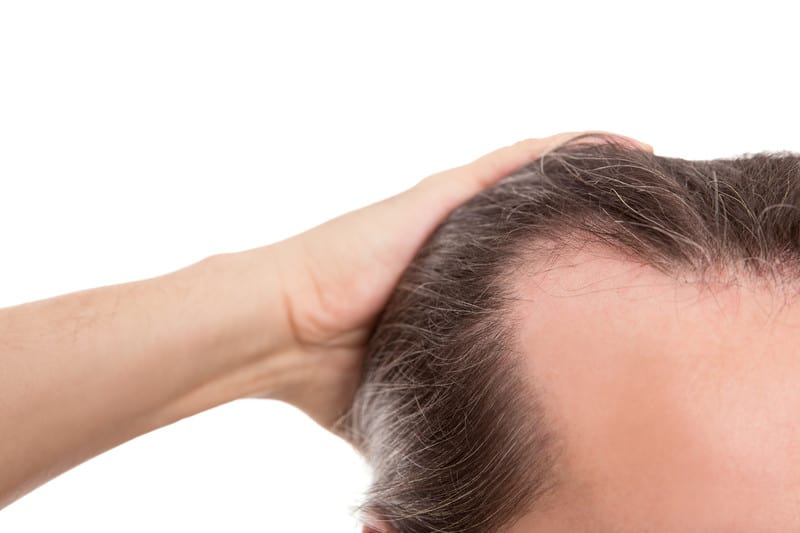 FUT vs FUE Hair Transplant – Which is Better?