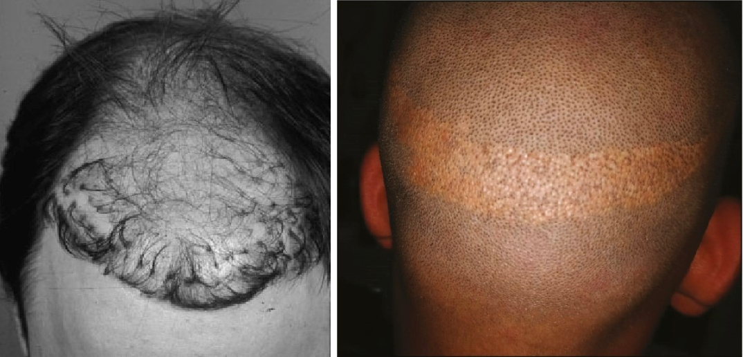 old fashioned hair plugs (left) and overharvesting scars from a bad hair transplant (right)