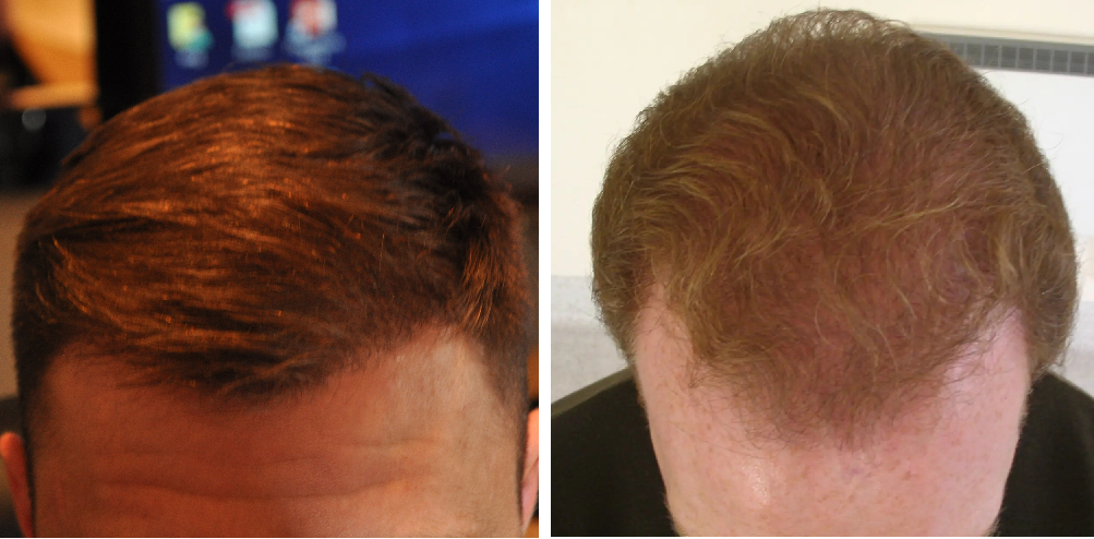 hairline hair transplant results