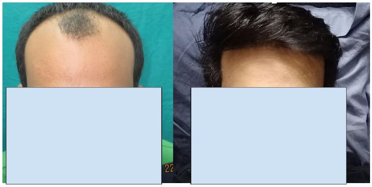 How Long Does A Hair Transplant Last? | Blog | Wimpole Clinic