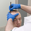 How Long Does A Hair Transplant Take?